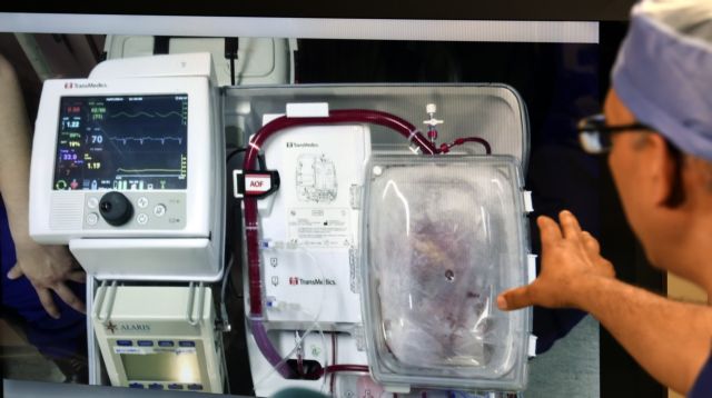 Σε Ελληνίδα η μεταμόσχευση της πρώτης «νεκρής» καρδιάς
