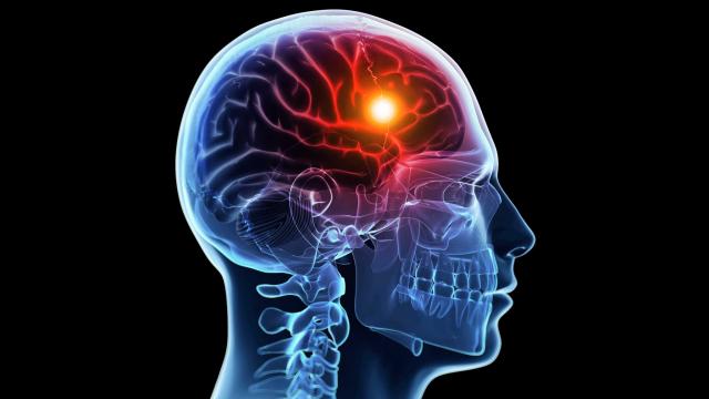 Μορφωτικό επίπεδο και «κενά» μνήμης προδιαθέτουν σε εγκεφαλικό επεισόδιο