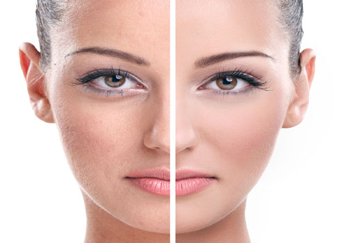 Μεσοθεραπεία PRP: Αναγέννηση της επιδερμίδας «εκ των έσω»