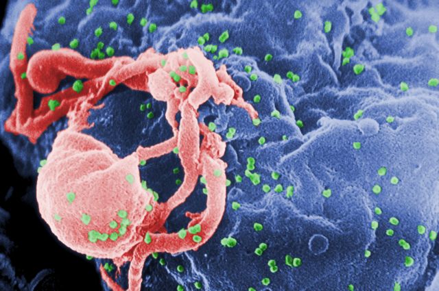 Επιθετικό στέλεχος του HIV προκαλεί AIDS σε 1 με 3 χρόνια