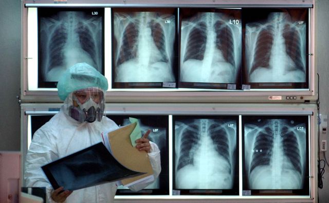 ΚΕΕΛΠΝΟ: Αύξηση των κρουσμάτων φυματίωσης την τελευταία τριετία