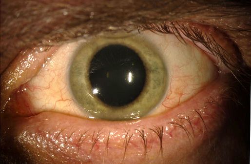 Ασθενής που «θεραπεύτηκε» από Έμπολα είδε το μάτι του να αλλάζει χρώμα