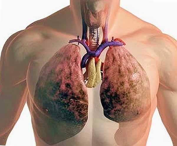 Φαρμακευτικός συνδυασμός βελτιώνει τη ζωή των ασθενών με κυστική ίνωση