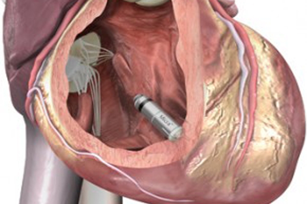 Βηματοδότης-μινιατούρα αλλάζει το τοπίο στη διαχείριση της βραδυκαρδίας