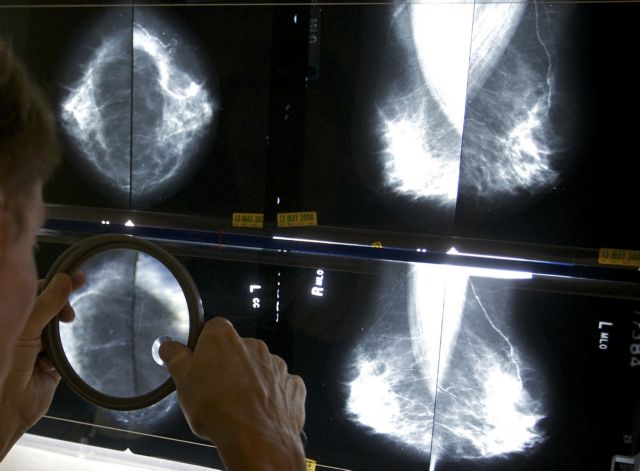 Η μαστογραφία μειώνει κατά 40% τον κίνδυνο θανάτου από καρκίνο
