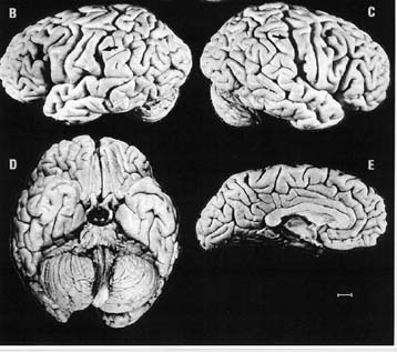 Καινούρια στοιχεία για την Αλτσχάιμερ