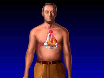 Φρένο στις μεταμοσχεύσεις καρδιάς συνιστά νέα έρευνα