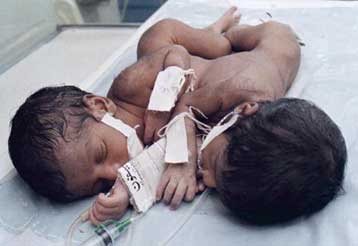 Ηθικό στήριγμα δίνει η Καθολική Εκκλησία στους γονείς των σιαμαίων στη Βρετανία