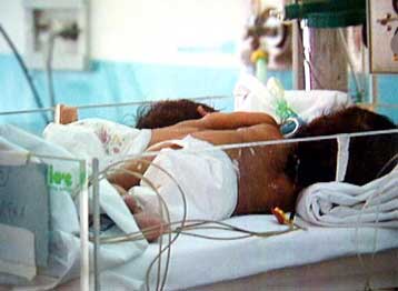 Βρετανικό δικαστήριο αποφασίζει το χωρισμό σιαμαίων παρά την άρνηση των γονέων