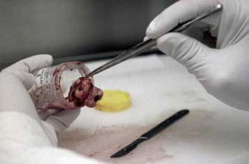 Μετριάζεται ο κίνδυνος επιδημίας από την Κρόιτσφελντ – Γιάκομπ