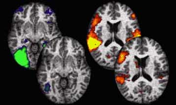 Ερευνητές «βλέπουν» τον εγκέφαλο να θυμάται