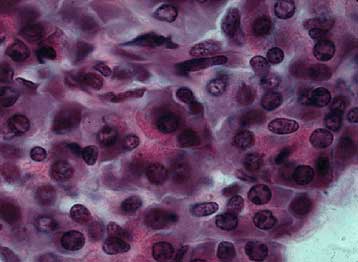 Ερευνητές ανακαλύπτουν τα βιοχημικά αίτια της παγκρεατίτιδας