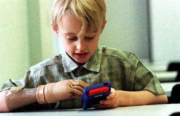 Βιονικό χέρι δίνει ελπίδα σε ανάπηρα παιδιά