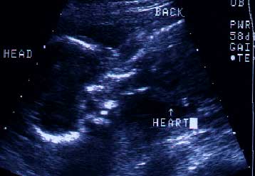 Νέος με ειδικές ανάγκες κερδίζει αποζημίωση από τους γιατρούς που επέτρεψαν τη γέννησή του