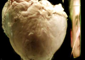 Βλαστικά κύτταρα από το μυελό των οστών επιδιορθώνουν τις βλάβες του μυοκαρδίου