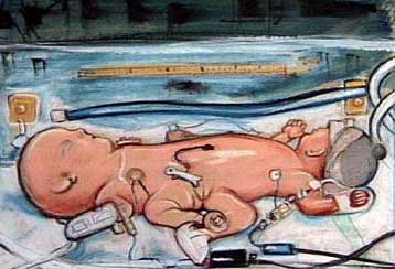 Σώθηκε το ένα από τα σιαμαία δίδυμα στη Βρετανία έπειτα από την επέμβαση χωρισμού τους