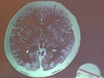 Επιστήμονες αναπτύσσουν διαγνωστικό τεστ για τη σχιζοφρένεια