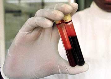 Τα τεστ που γίνονται το απόγευμα είναι, πολλές φορές, αναξιόπιστα για τη διάγνωση του διαβήτη