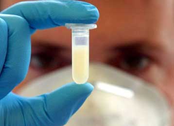 Η 57χρονη ασθενής στο ΓΝΑ δεν πάσχει από τη νόσο των «τρελών αγελάδων»