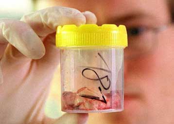 Συμπτώματα σπογγώδους εγκεφαλοπάθειας σε 57χρονη γυναίκα προκαλούν ανησυχία στους επιστήμονες