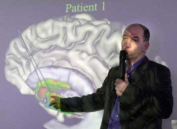 Επιστήμονες ανακάλυψαν πρώιμα σημάδια της σχιζοφρένειας στον εγκέφαλο