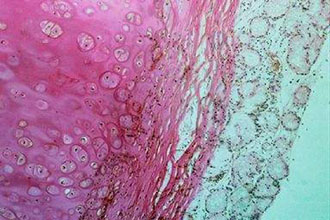 Νέο διαγνωστικό τεστ για τον καρκίνο της ουροδόχου κύστης