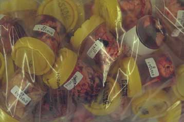 Δύο νέα κρούσματα σπογγώδους εγκεφαλοπάθειας σε Ιταλία και Σουηδία