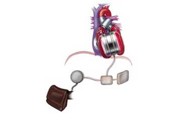 Μόνιμη τεχνητή καρδιά θα δοκιμαστεί σύντομα στις ΗΠΑ