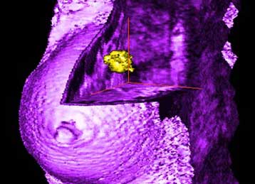 Έγινε γνωστός ο μηχανισμός μετάστασης του καρκίνου του μαστού