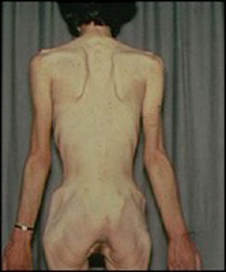 Αυξάνονται οι διατροφικές διαταραχές στη Βρετανία