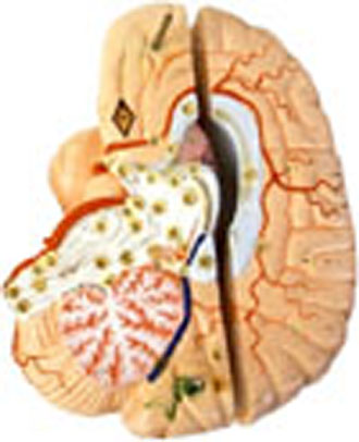 Δυσλεξία: Έγκαιρη διάγνωση με μαγνητική τομογραφία