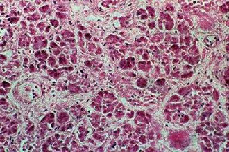 Τη σχέση μεταξύ του καρκίνου και των ιών μελετούν Σκοτσέζοι