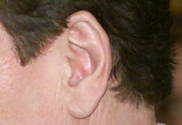 Ερευνητές δημιουργούν νευρικά κύτταρα για την αποκατάσταση της ακοής