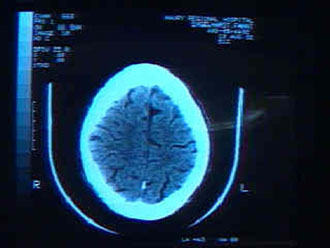 Αντισώματα κατά της νόσου Αλτσχάιμερ