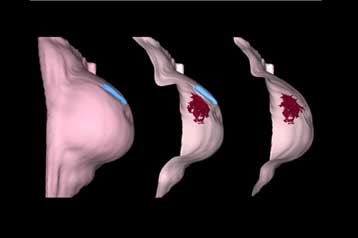Οι χημοκίνες είναι τα μόρια – κλειδιά για την πρόληψη της μετάστασης