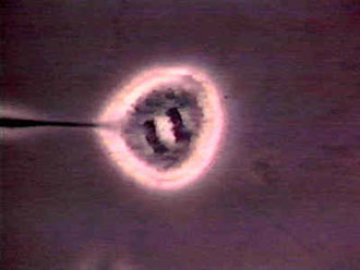 Αισιόδοξα μηνύματα για τη μυϊκή δυστροφία