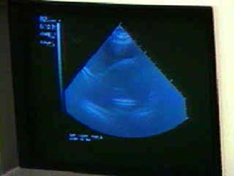 Το υπερηχογράφημα οδηγός για την απόφαση της σωστής αντικαρκινικής θεραπείας