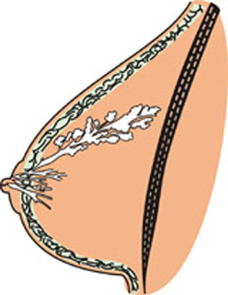 Ο καρκίνος του μαστού προσβάλλει 4.500 Ελληνίδες το χρόνο