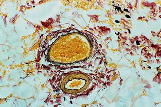 Αντιμετωπίζοντας τον καρκίνο σήμερα…