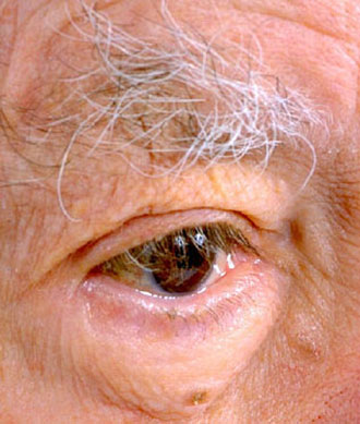 Γεροντική εκφύλιση της ωχράς κηλίδας. Πρόληψη και θεραπευτική αντιμετώπιση