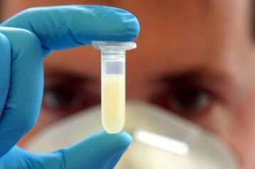 Γενετικά τροποποιημένα κύτταρα μεταμοσχεύονται σε ασθενή της νόσου του Αλτσχάιμερ