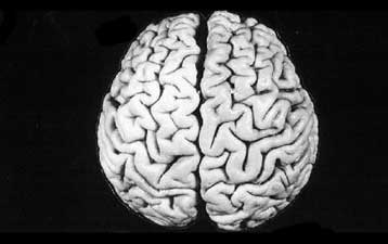 Εντοπίστηκε ιός που πιθανώς σχετίζεται με τη σχιζοφρένεια