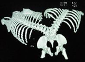 Οστεοπόρωση: Μια νόσος με μοναδική συντηρητική θεραπεία