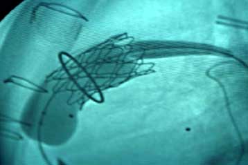 Επαναστατική μέθοδος επιτρέπει την παράκαμψη των στεφανιαίων χωρίς ανοιχτή επέμβαση