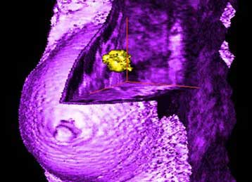 Διακόπτονται οι δοκιμές του «εμβολίου» για τον καρκίνο του μαστού