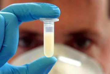 Θεραπεία για τη νόσο του Αλτσχάιμερ; «Θαυματουργή» πρωτεΐνη σταματά το θάνατο των εγκεφαλικών κυττάρ