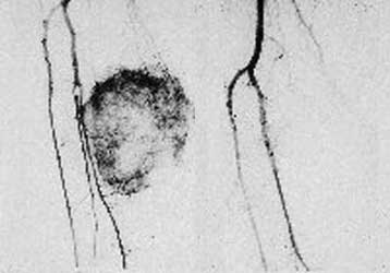 Οι σοβαρές λοιμώξεις εμποδίζουν έμμεσα την ανάπτυξη των καρκινικών όγκων