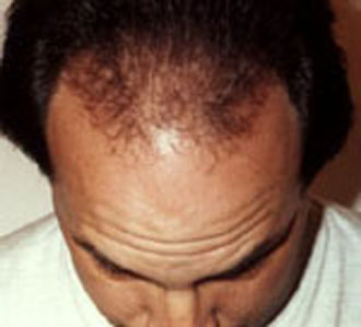 Σπατάλη εκατομμυρίων για… τρίχες