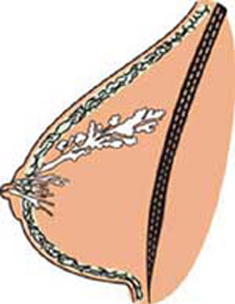 Απλό τεστ ανιχνεύει την πιθανότητα εμφάνισης καρκίνου του μαστού