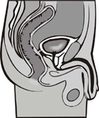 Δύο νέα φάρμακα επιβραδύνουν τη μετάσταση του καρκίνου του προστάτη στα οστά